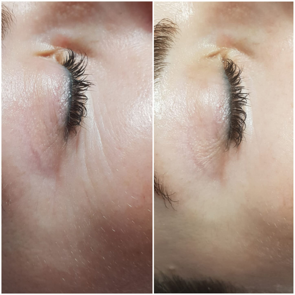 Before & After Plasma Pen Eyes
